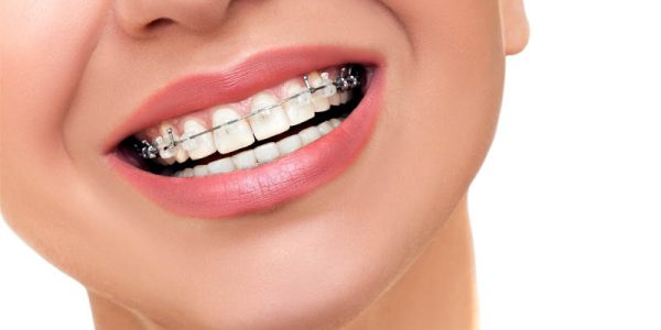 orthodontics braces