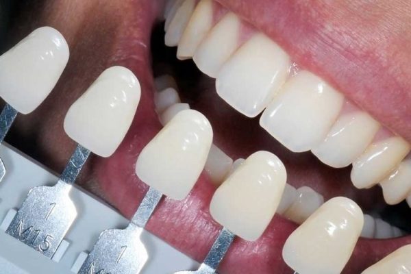 tooth-colored-fillings-photo-1200