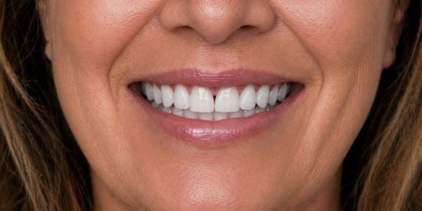 F after Fillings