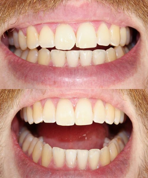 Edited Before and After Fillings